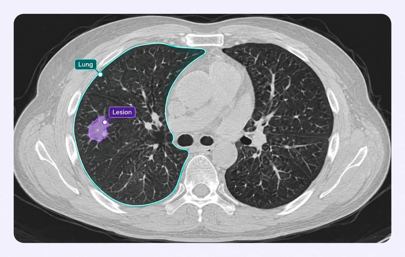 Chest CT with separate lung and lesion region labels.