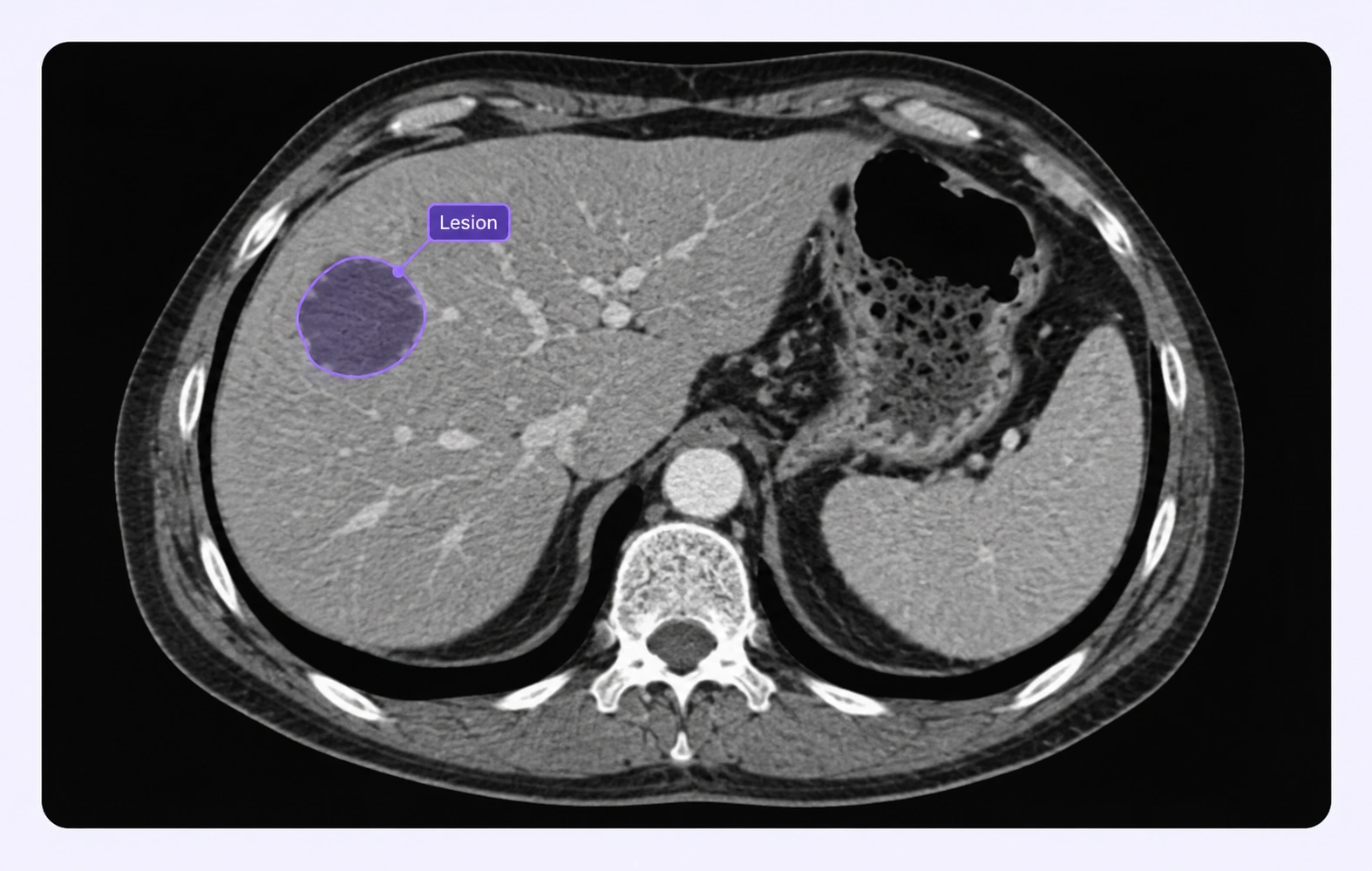 Abdominal CT with a focal lesion region annotated.