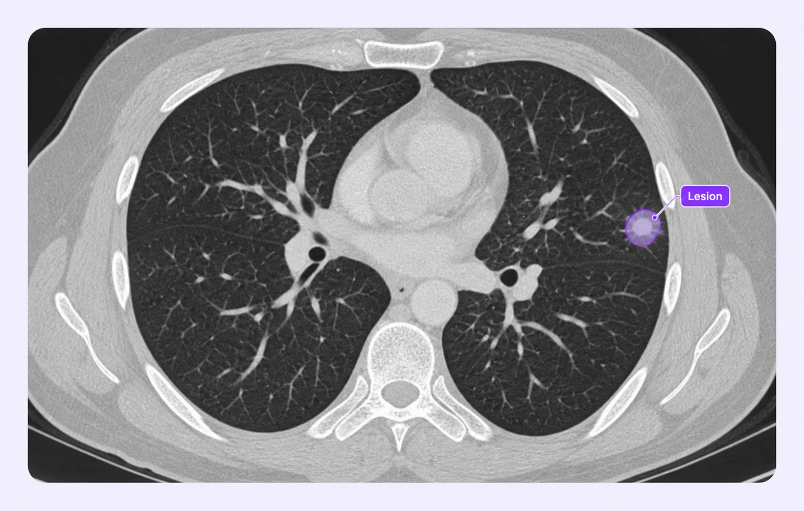 Chest CT with a small lung lesion region annotated.