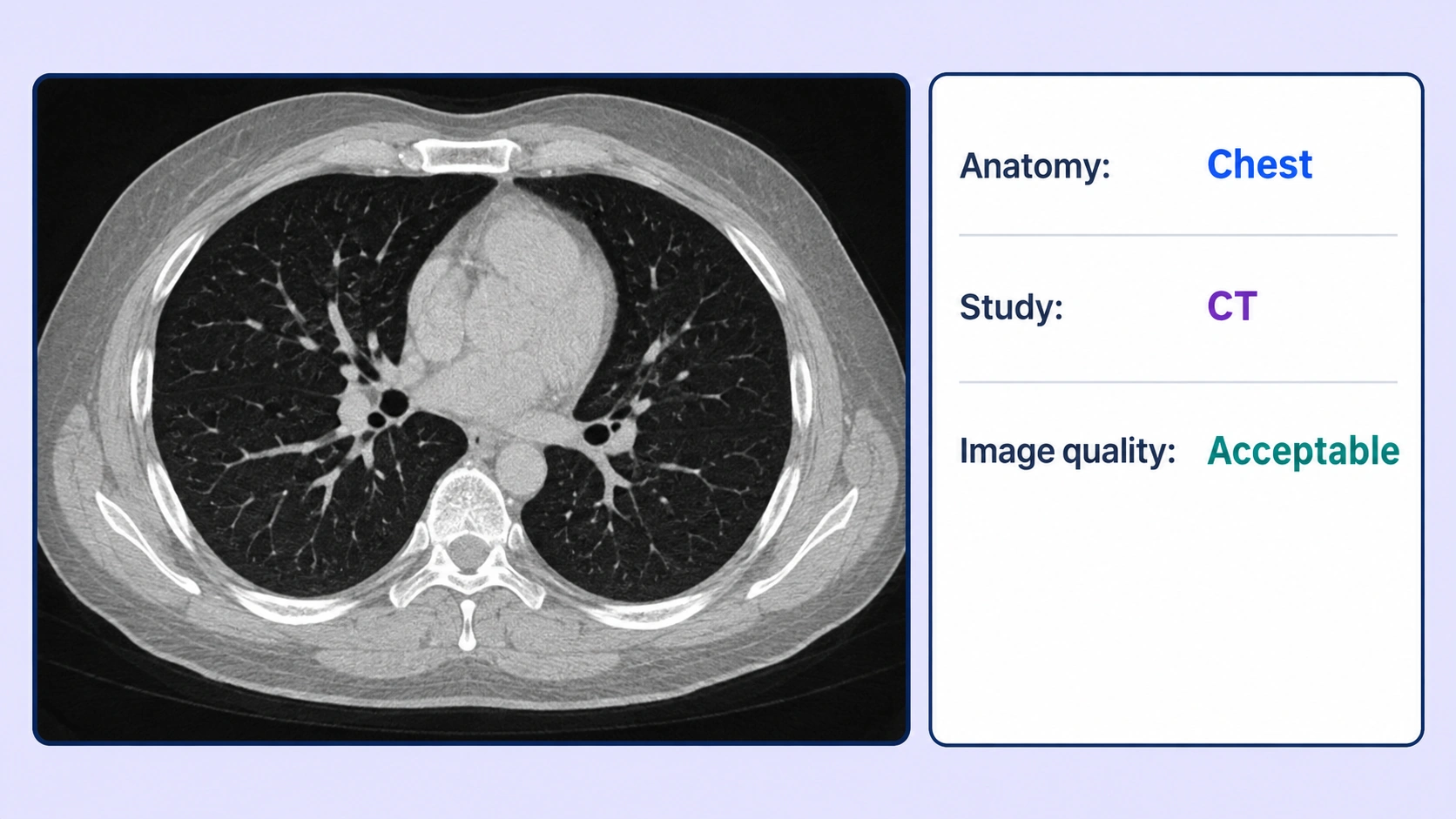 Chest CT image with whole-image annotation properties for anatomy, study type, and image quality.