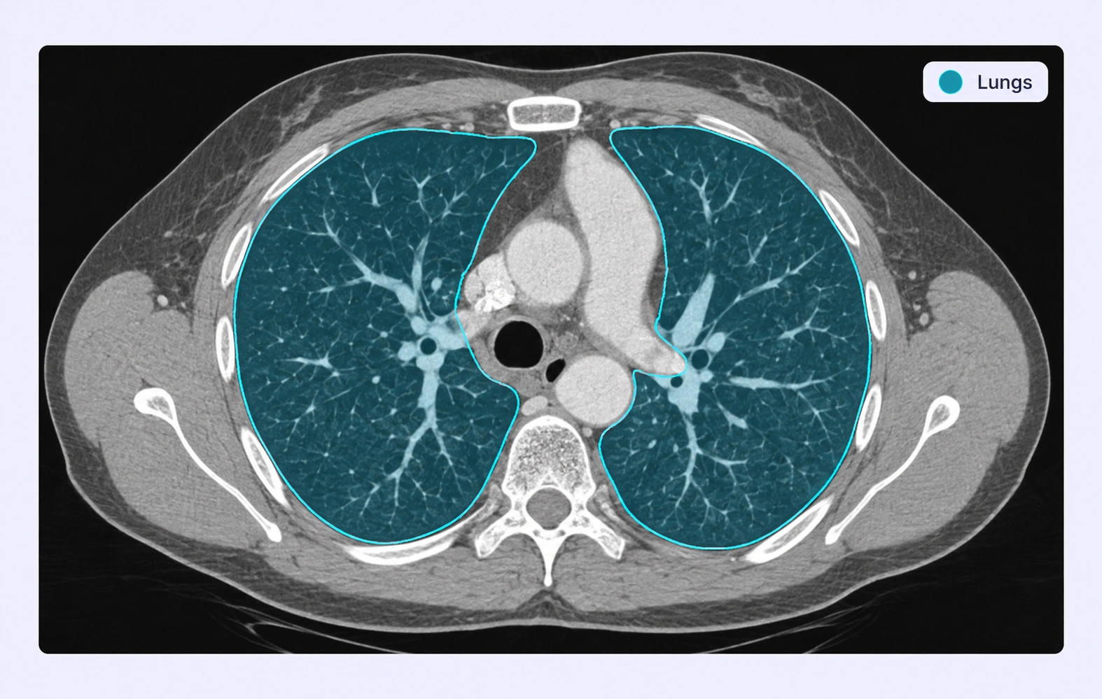 Chest CT with lung segmentation masks.