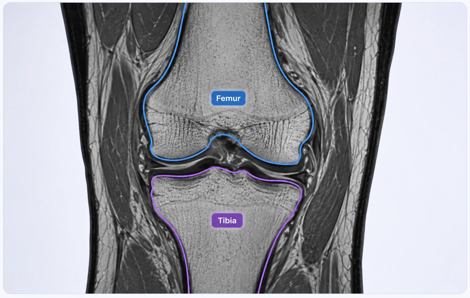 Knee MRI with femur and tibia anatomical contours.