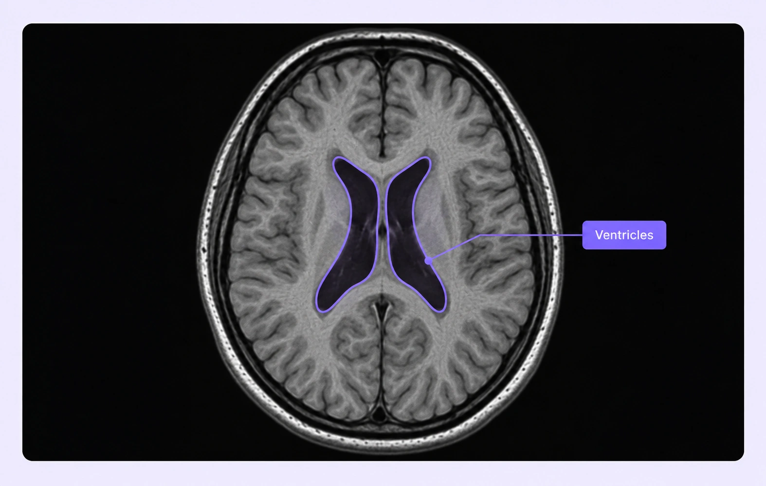 Brain MRI with labeled ventricular regions.