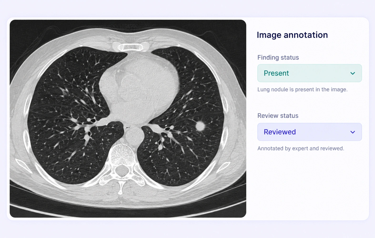 Chest CT assigned an expert-defined finding-present item label.