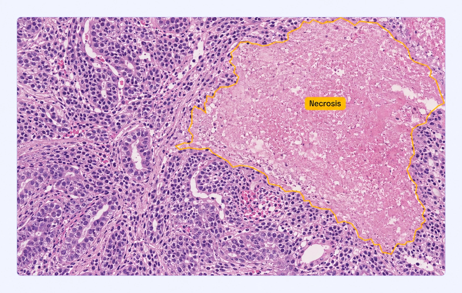 Histology with a necrotic tissue region annotated. Histology with a necrotic tissue region annotated.