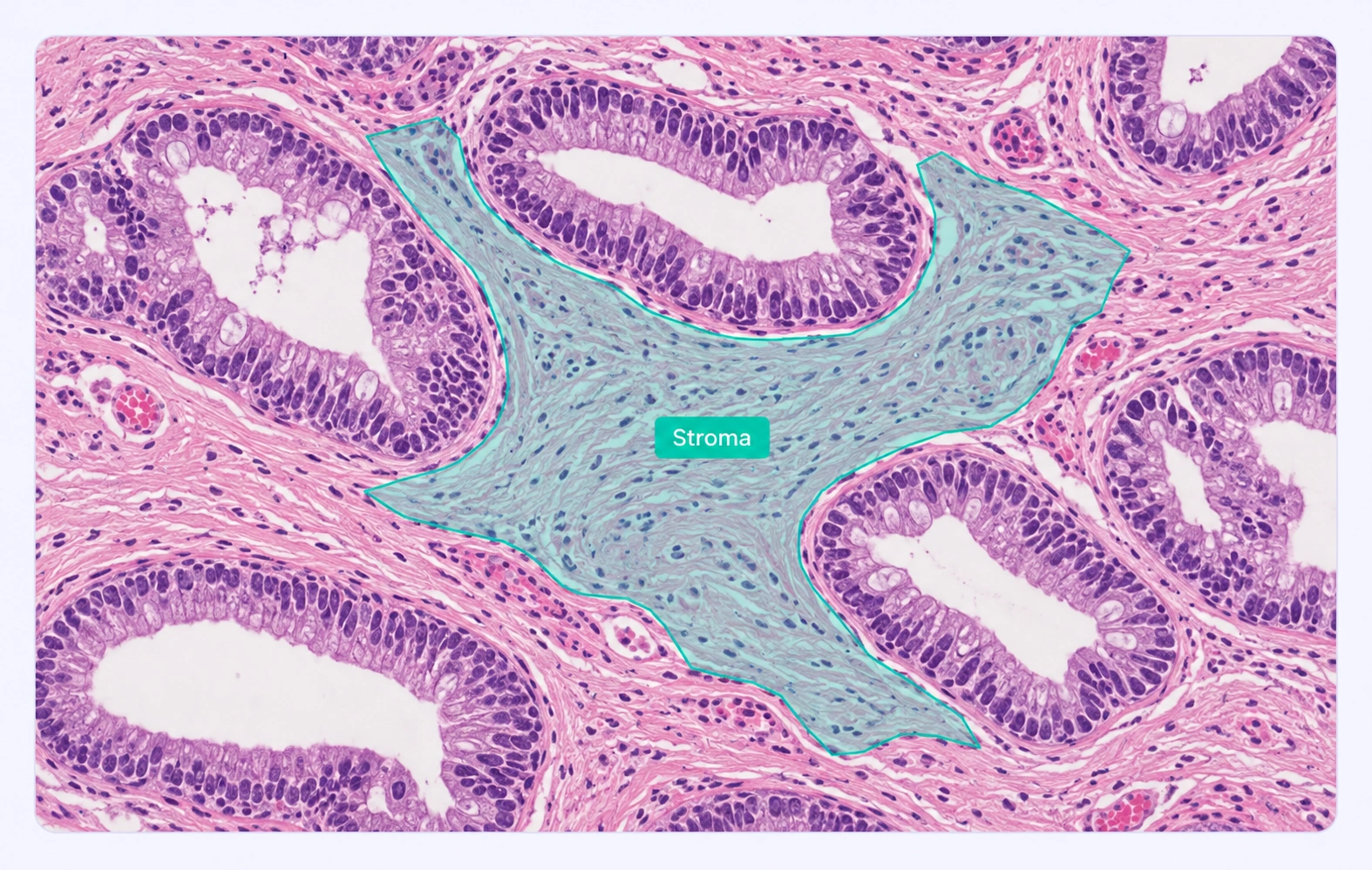 Histology with a stromal tissue region outlined and labeled. Histology with a stromal tissue region outlined and labeled.