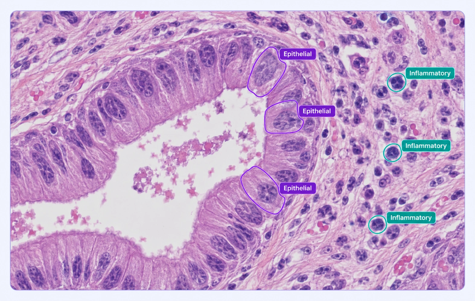 Histology cells annotated with epithelial and inflammatory classes. Histology cells annotated with epithelial and inflammatory classes.