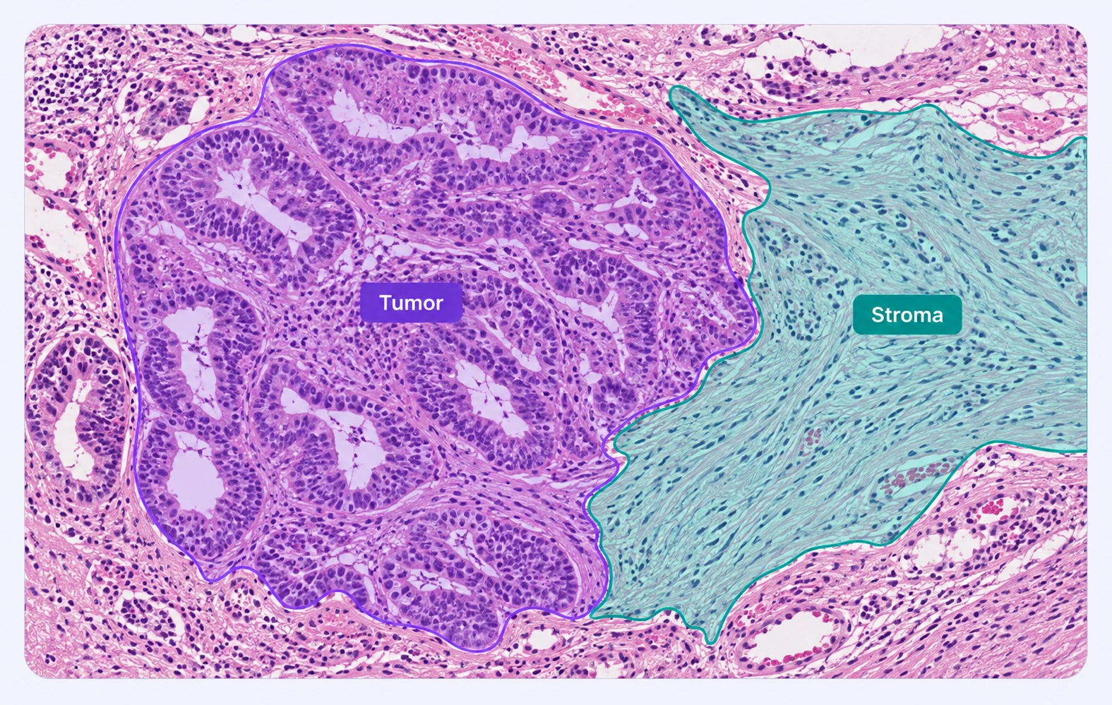 Histology with separate tumor and surrounding stromal region annotations.
