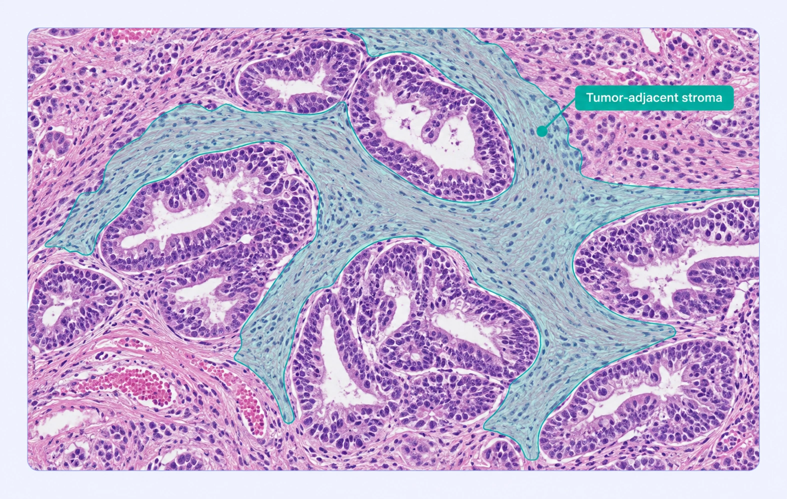 Histology with tumor-adjacent stroma labeled as a separate region.