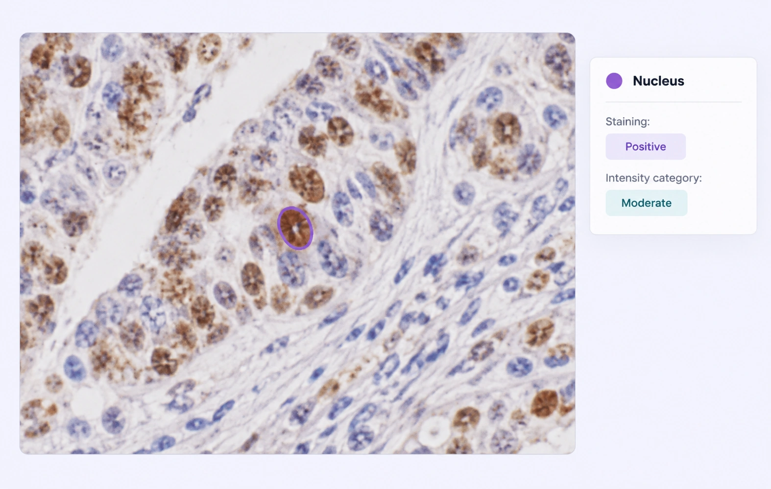 IHC region with positive staining and expert-defined intensity properties.