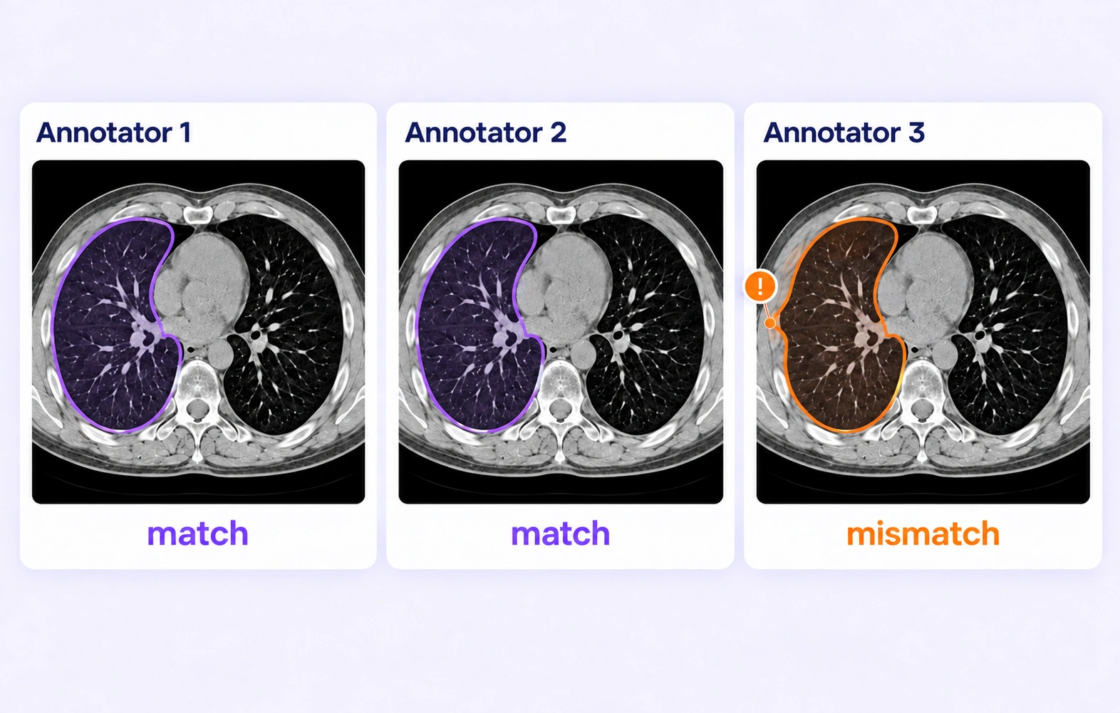 Independent contours on the same chest CT slice expose a lung boundary extending into chest-wall tissue. Independent contours on the same chest CT slice expose a lung boundary extending into chest-wall tissue.