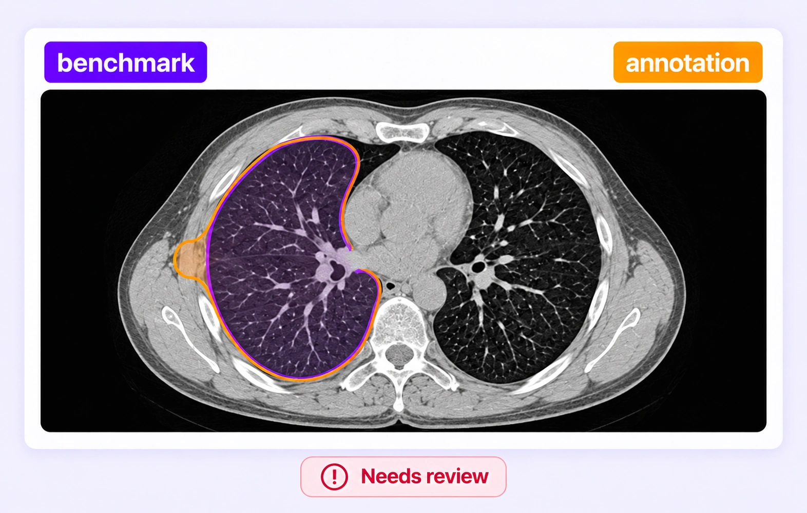 A lung contour extending into chest-wall tissue is compared with the approved benchmark on the same CT slice. A lung contour extending into chest-wall tissue is compared with the approved benchmark on the same CT slice.