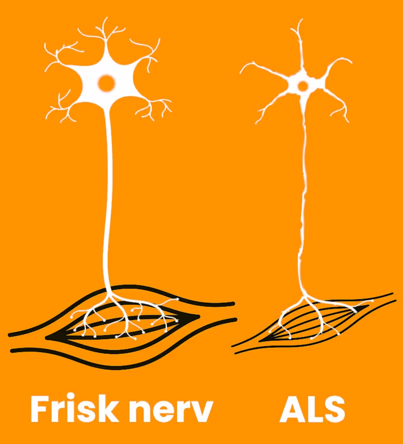 En frisk nerv bredvid en nerv hos någon drabbad av ALS.