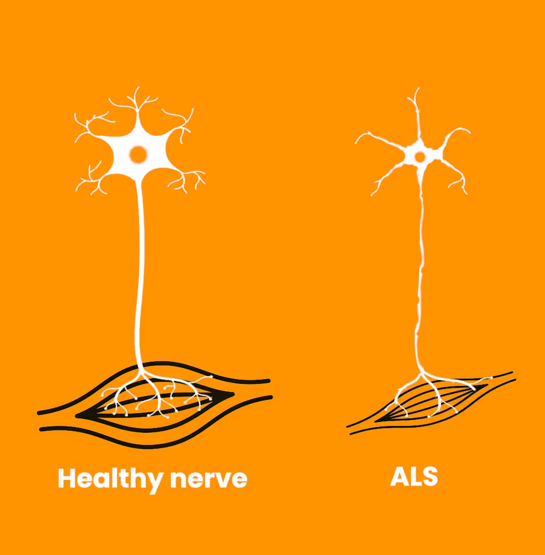 Illustration comparing a healthy nerve with many branches connected to a muscle and an ALS-affected nerve with fewer branches and a thinner connection to the muscle.