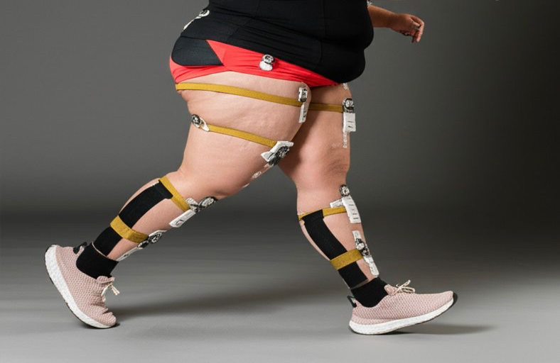 Alterações Biomecânicas no Lipedema: Impacto na Postura, Marcha e Função