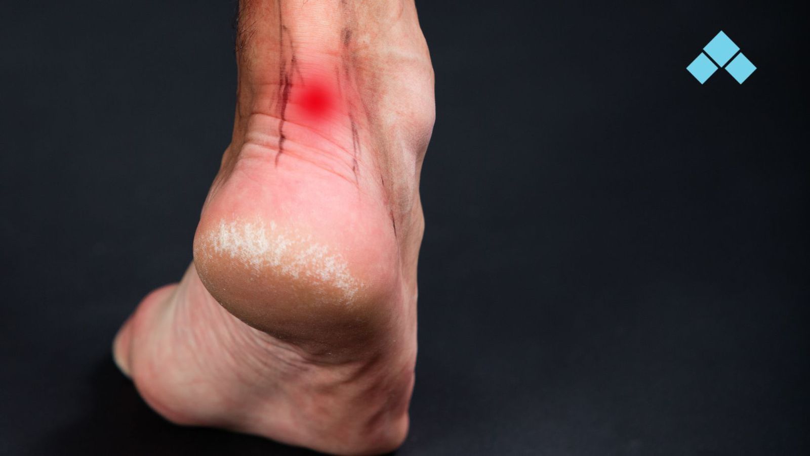 Terapia por Ondas de Choque no Tratamento da Fasciíte Plantar e da Tendinopatia Crônica do Tendão de Aquiles