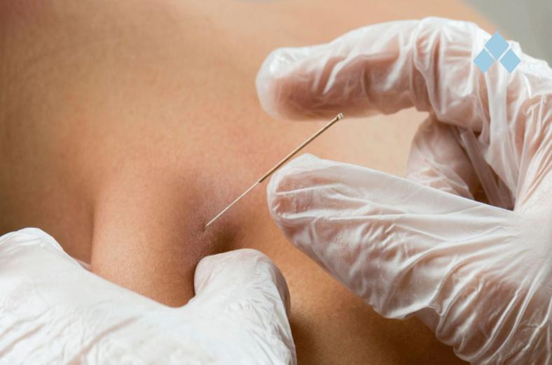 Dry Needling: Uma das Terapias da Núcleo Alma para Alívio Rápido da Dor Muscular