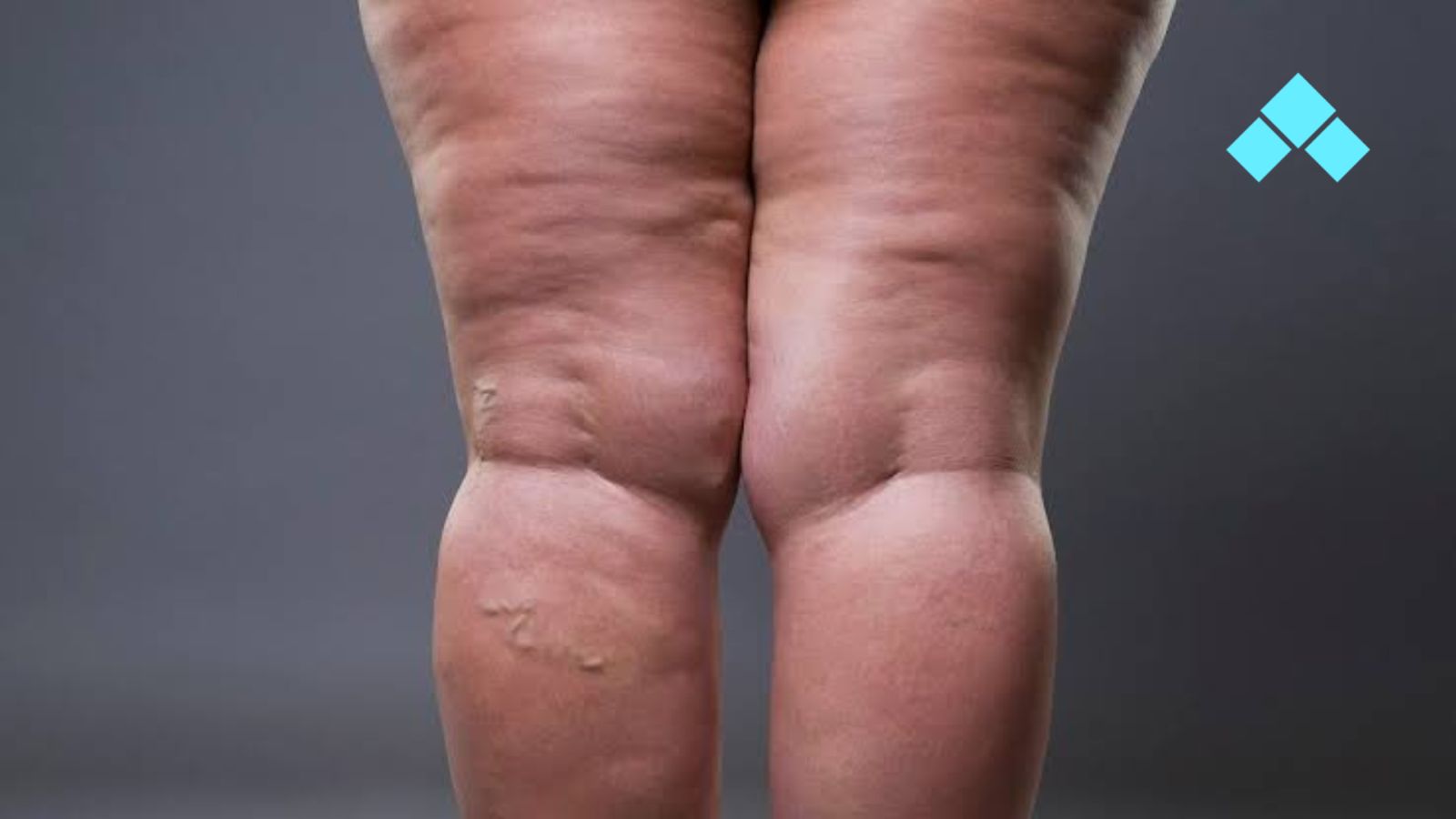 Lipedema e Fisioterapia Integrativa: Tratamento Humanizado para Dor, Inchaço e Qualidade de Vida