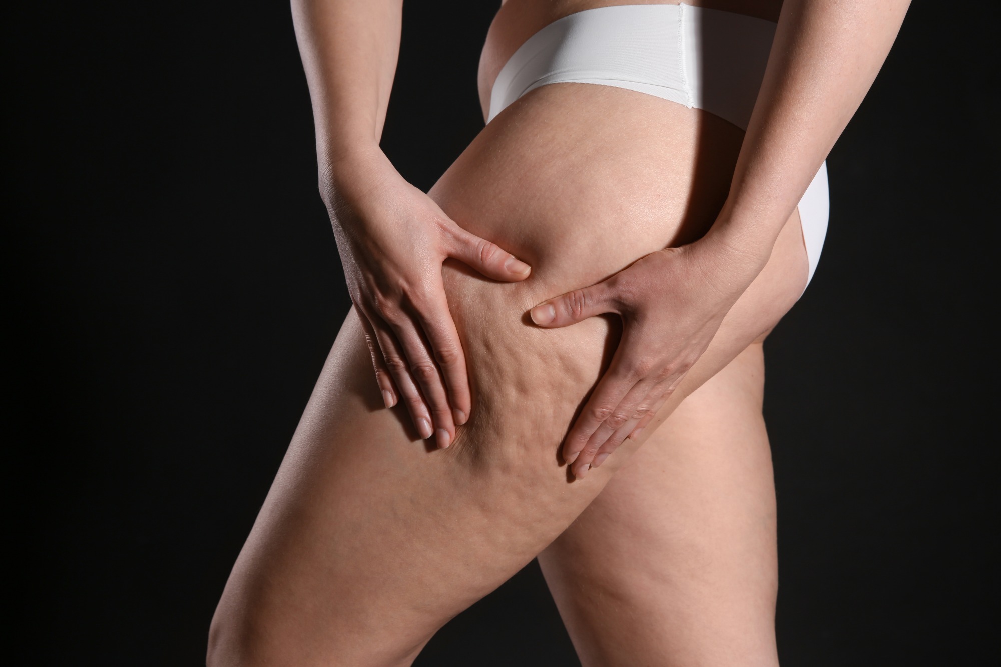 Genética, pele e lipedema: faça uma leitura mais precisa para o cuidado preventivo