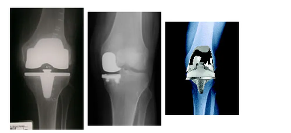 Röntgen vom Künstlichem Gelenk im Knie