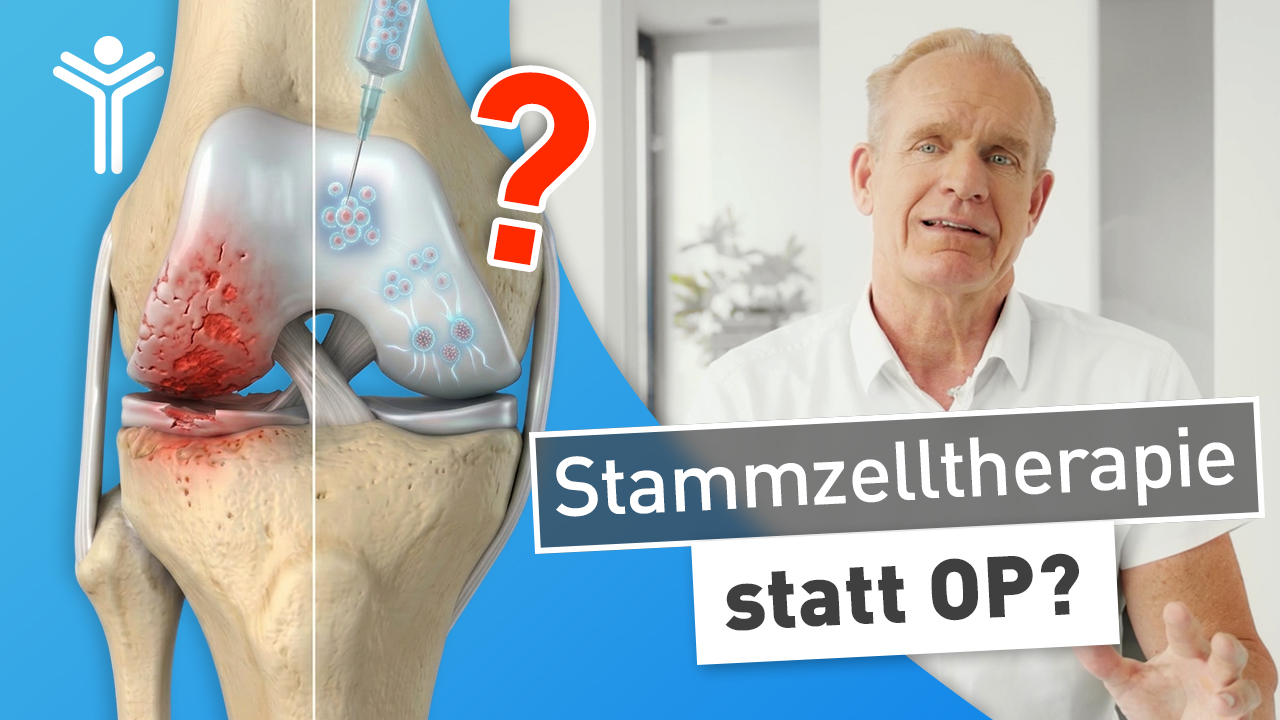 Stammzellentherapie bei Arthrose: Kann man Gelenkverschleiß mit Stammzellen heilen?
