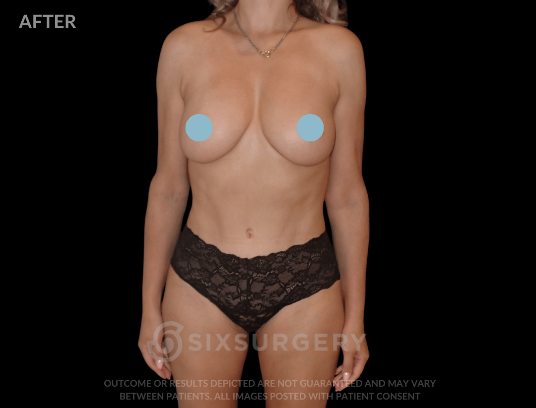 Mommy Makeover with Breast Reduction 55 year old