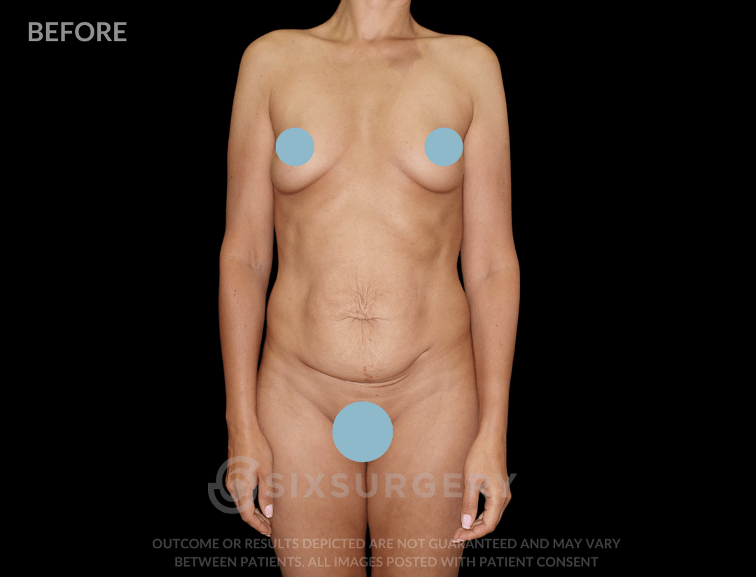 Mommy Makeover with Breast Reduction 55 year old