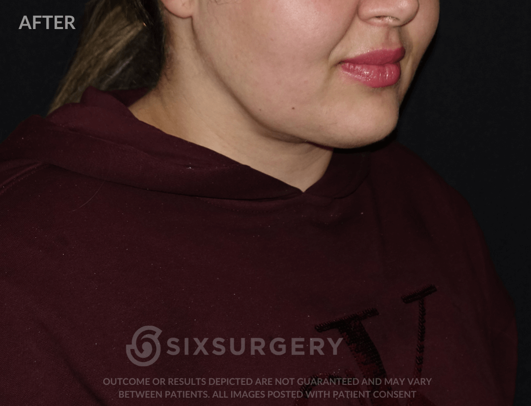 Neck Liposuction 45 year old