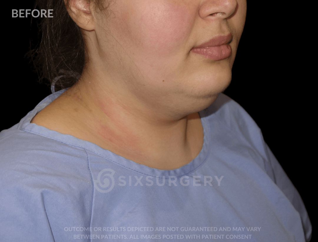 Neck Liposuction 45 year old