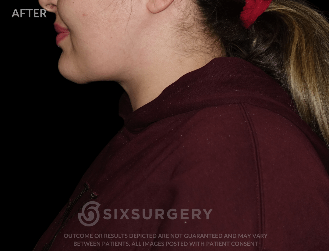 Neck Liposuction 45 year old