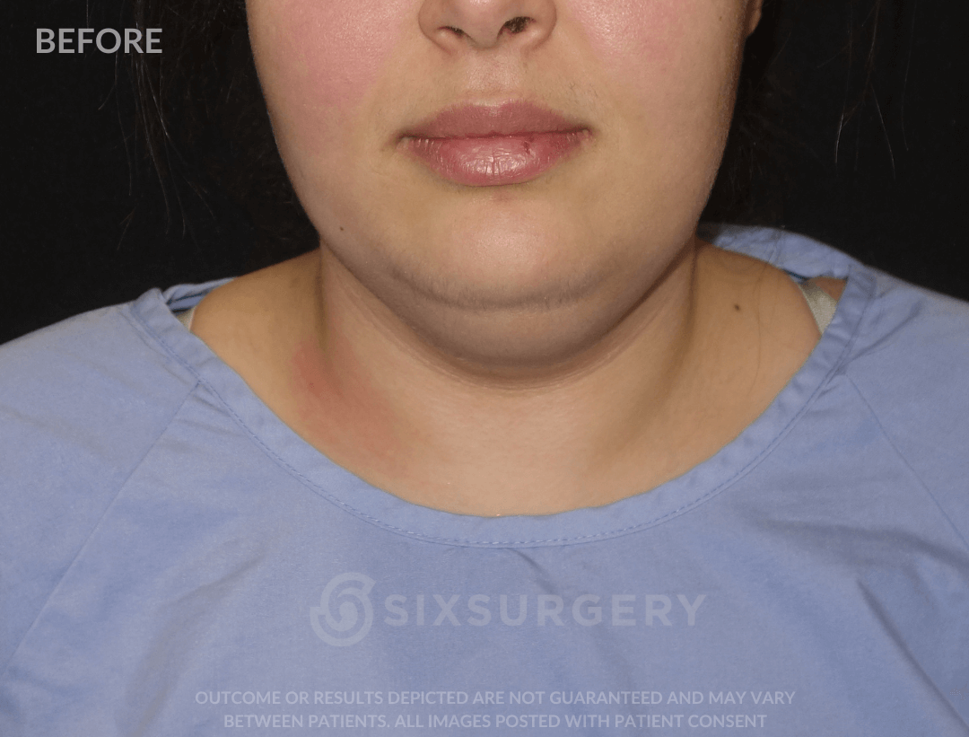 Neck Liposuction 45 year old