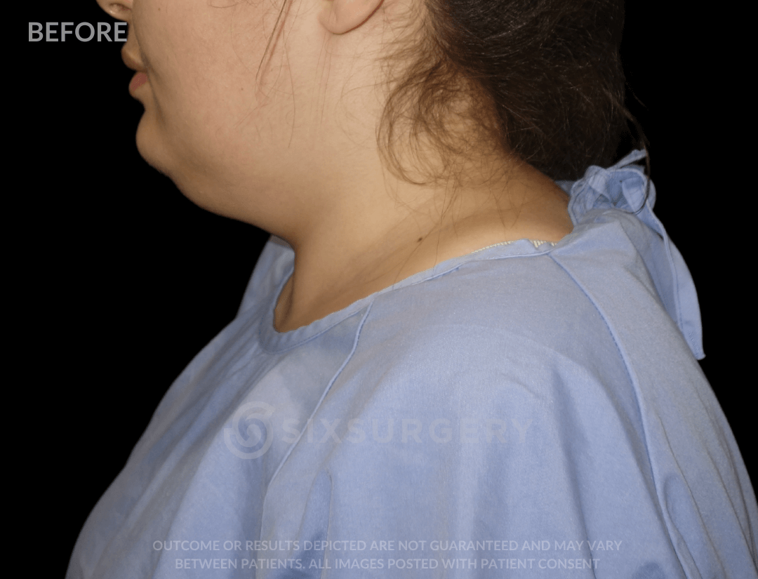 Neck Liposuction 45 year old
