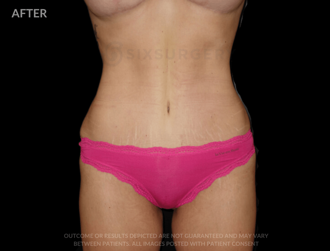 Tummy Tuck with Breast Reduction 5200cc Muscle Repair 57 year old 