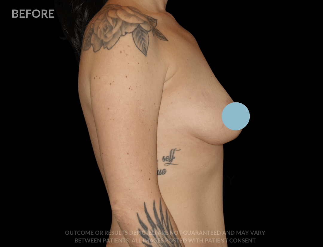 Breast Lift with Breast Augmentation 580cc 34 year old