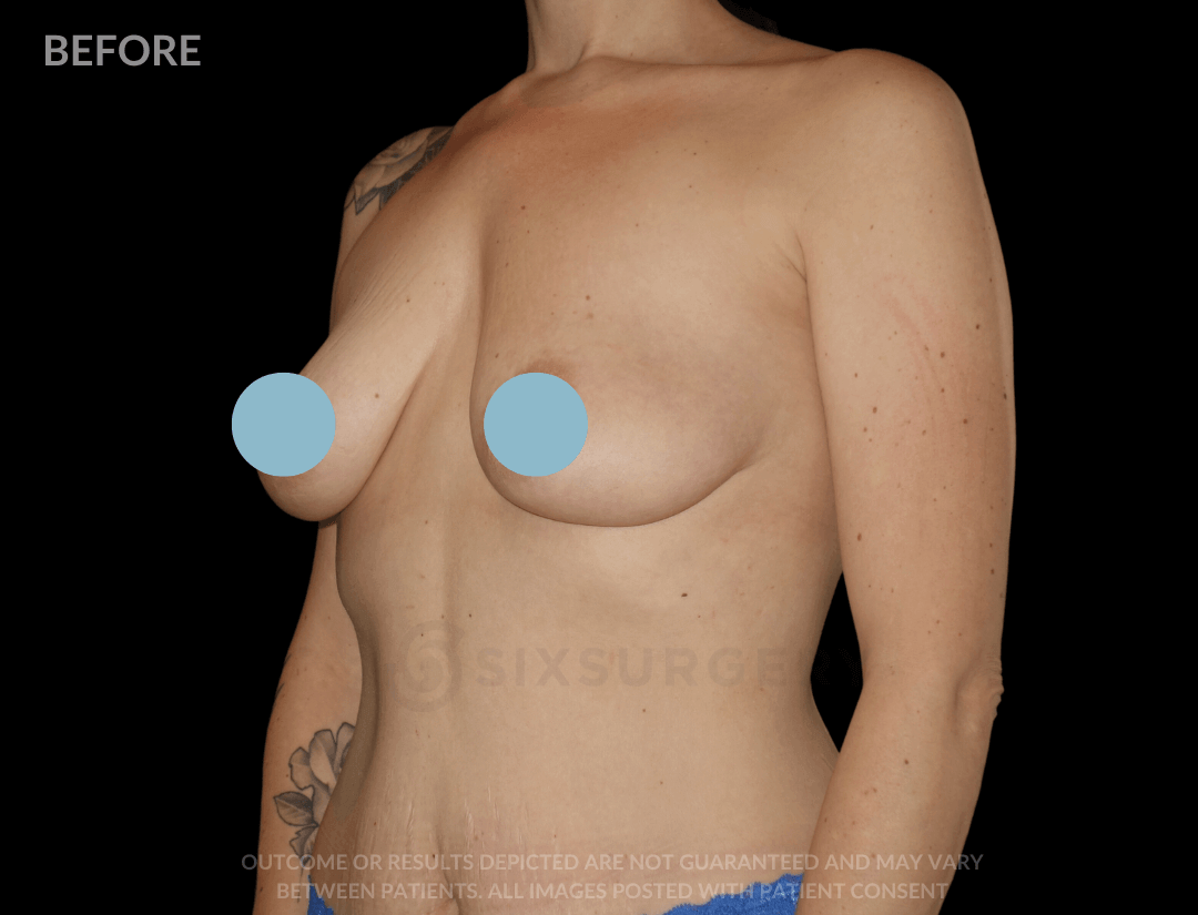 Breast Lift with Breast Augmentation 580cc 34 year old