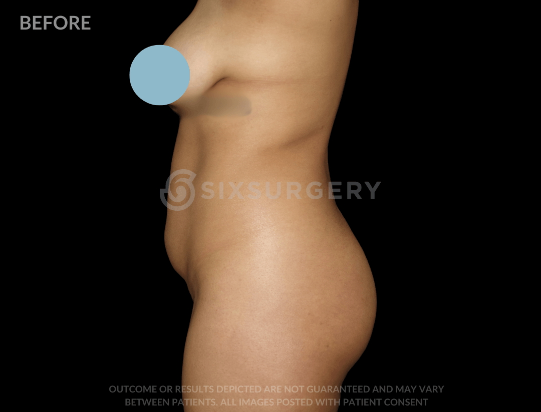 Liposuction 2500cc 52 year old