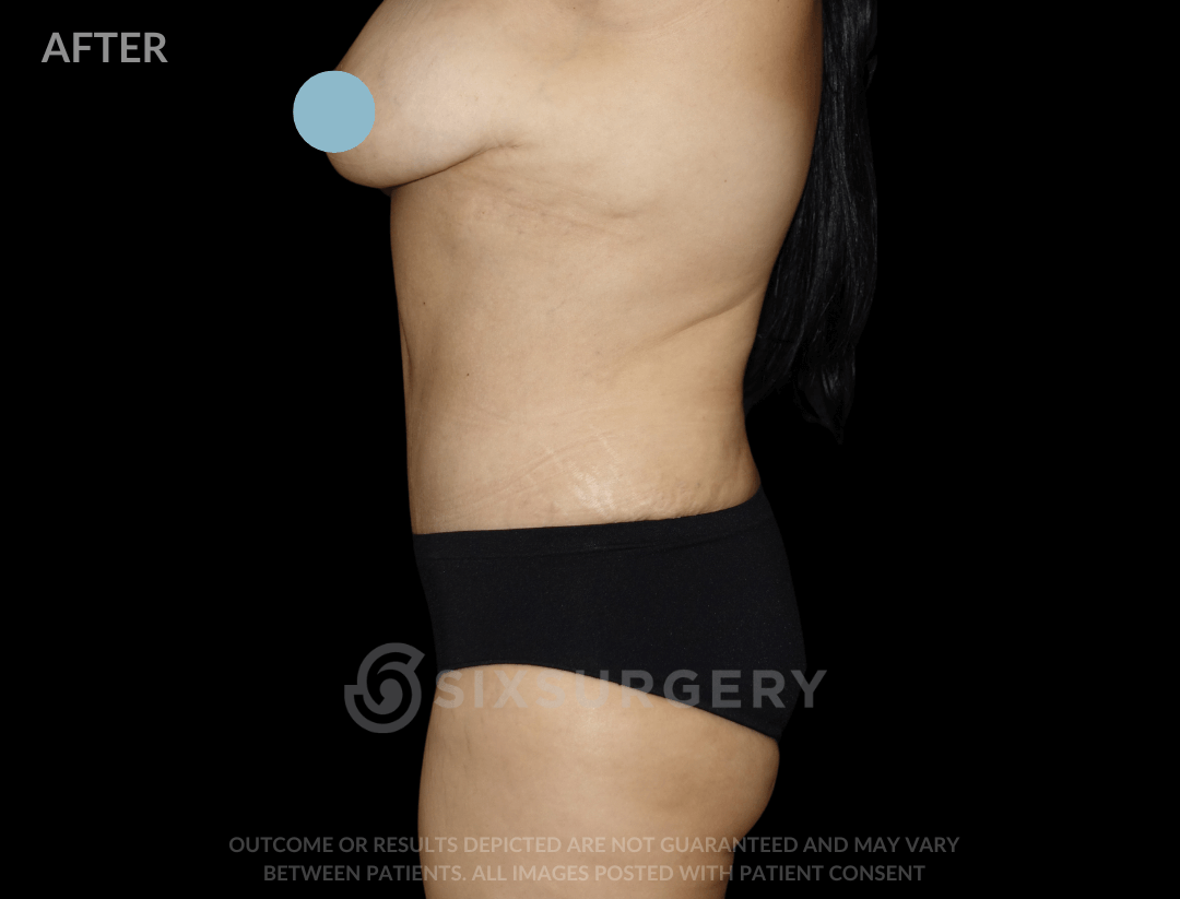 Mommy Makeover with Breast Reduction 55 year old