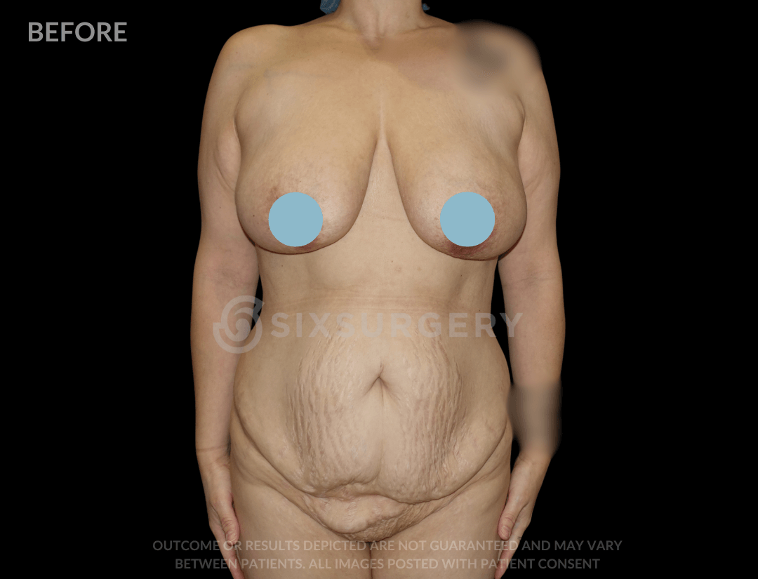 Mommy Makeover with Breast Reduction 55 year old