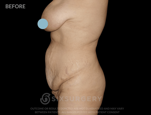 Mommy Makeover with Breast Reduction 55 year old