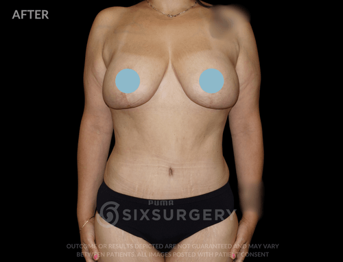 Mommy Makeover with Breast Reduction 55 year old