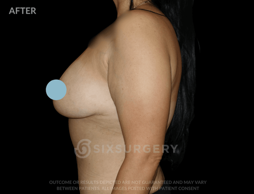 Breast Lift with Breast Augmentation 580cc 34 year old
