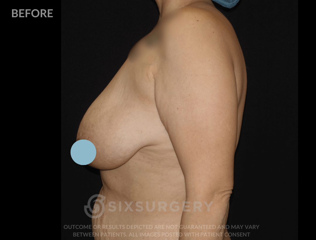 Breast Lift with Breast Augmentation 580cc 34 year old