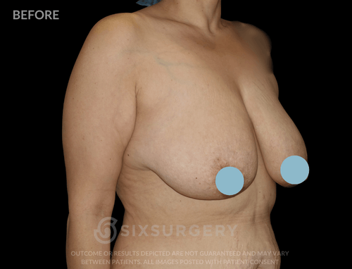 Breast Lift with Breast Augmentation 580cc 34 year old