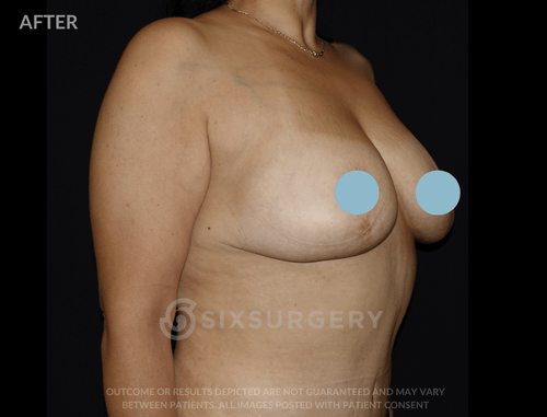 Breast Lift with Breast Augmentation 580cc 34 year old
