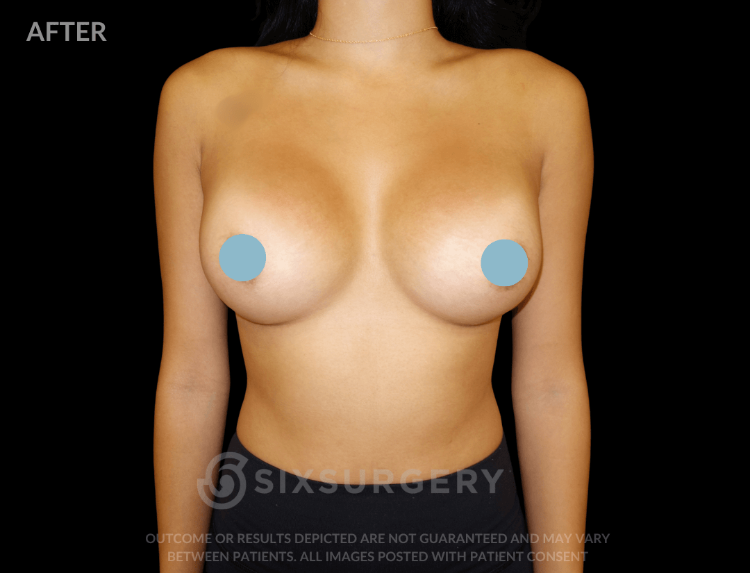 Breast Augmentation Silicone 450cc High Profile Breast fold White Female