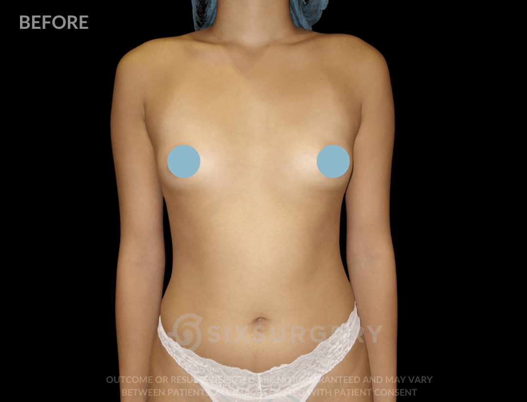 Breast Augmentation Silicone 450cc High Profile Breast fold White Female