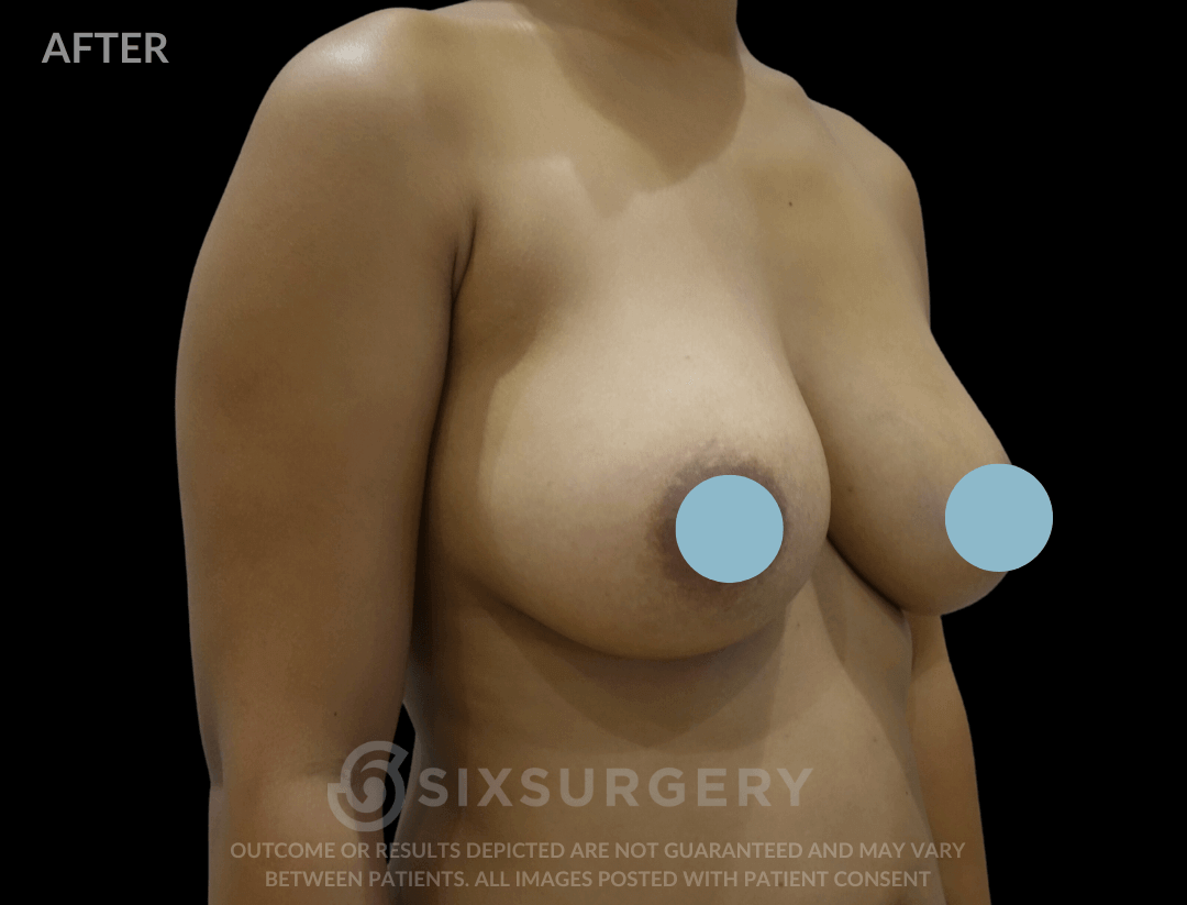 Breast Augmentation Silicone 450cc High Profile Breast fold White Female
