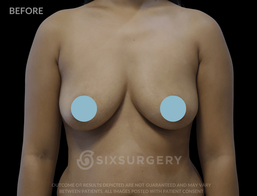Breast Augmentation Silicone 450cc High Profile Breast fold White Female
