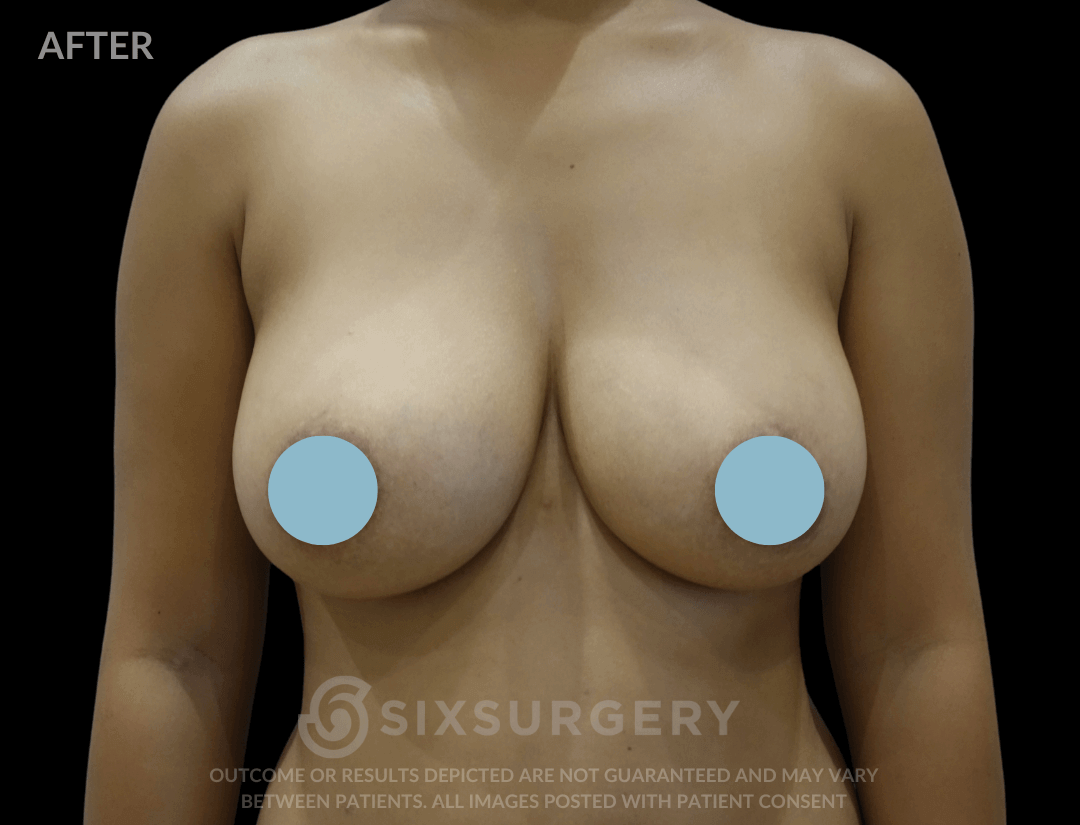 Breast Augmentation Silicone 450cc High Profile Breast fold White Female