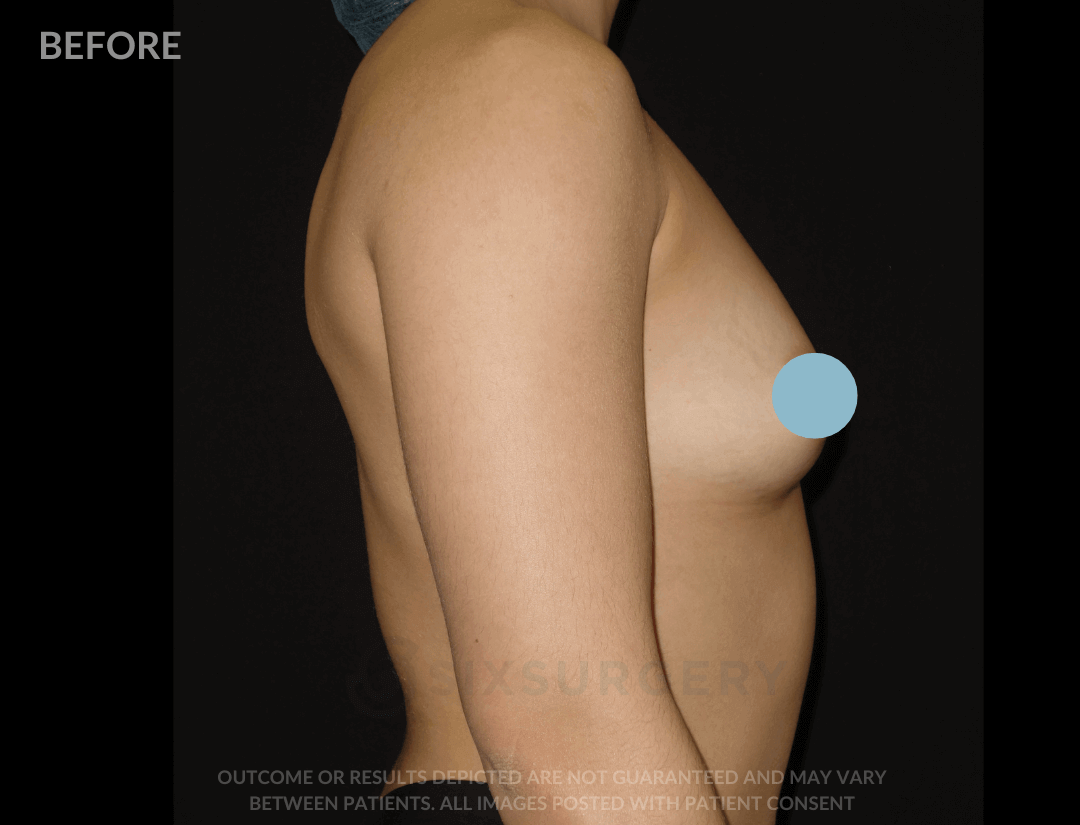 Breast Augmentation Silicone 450cc High Profile Breast fold White Female